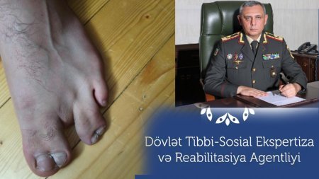 Ayağında 3 barmağı var, onlar da yararsız -